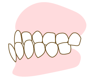 受け口